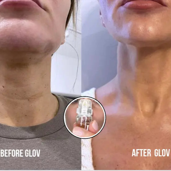 Sistema de microinfusión Glov Piel firme y elastica